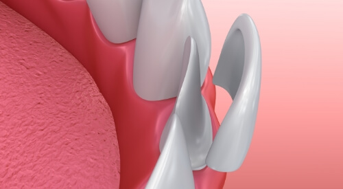 Illustrated veneer being placed over a tooth