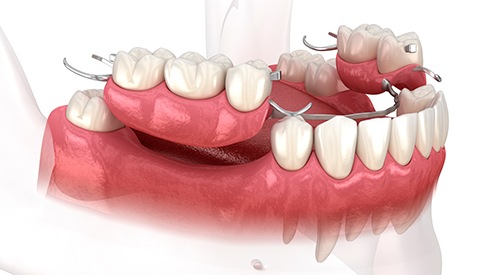 3D image of partial dentures