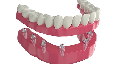 3D model of implant dentures