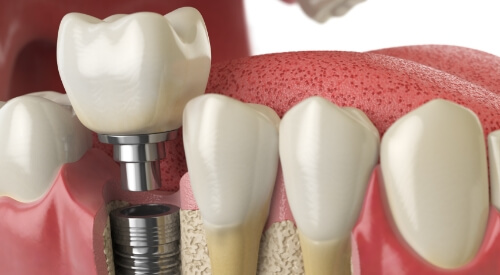 Illustrated dental crown being fitted onto a dental implant