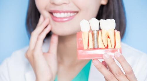 Dentist holding a model of a dental implant