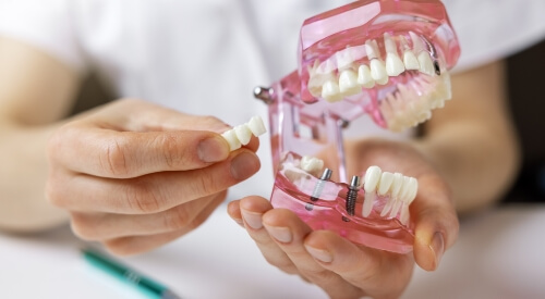 Dentist holding a model of the mouth and a dental bridge