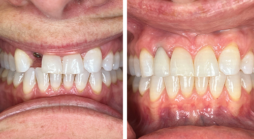 Dentist holding a model of a dental implant