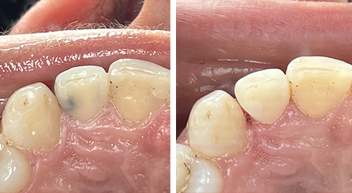 Illustrated tooth with a white filling