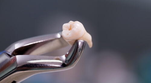 Dental clasp holding an extracted tooth