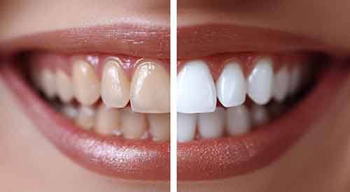 Side-by-side image of stained and whiter teeth